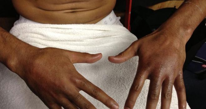 Amir Khan's hands after his fight with Carlos Molina