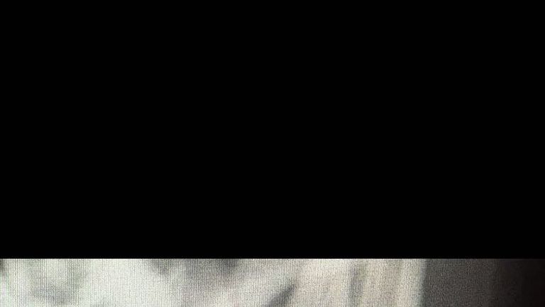 Eddie Hearn posted the X-rays of Quigg's broken jaw on Twitter