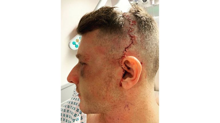 The GB hockey player posted images of his injury to social media (@samuel_ward13)